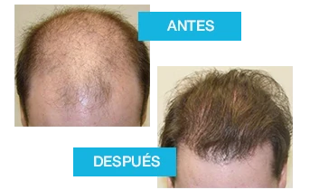 Transformación capilar con Profolan